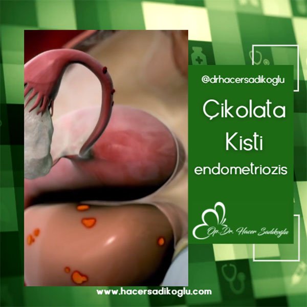Çikolata Kisti (endometriozis)
